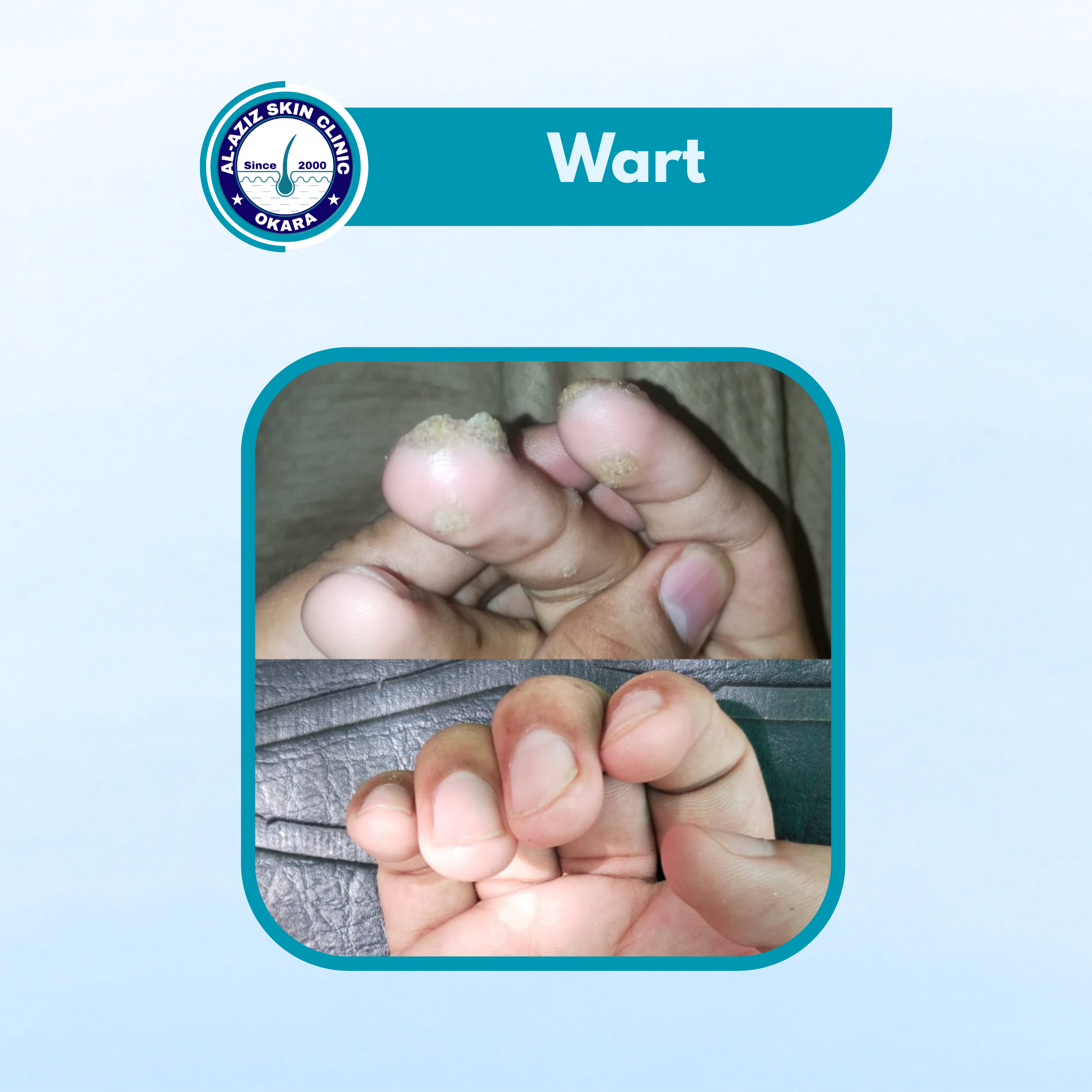Wart Treatment