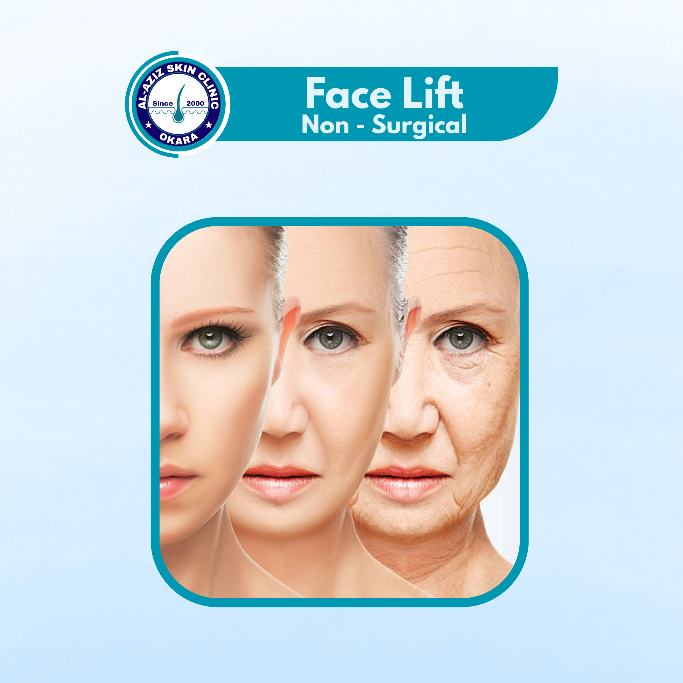 Face Lift (Non - Surgical)