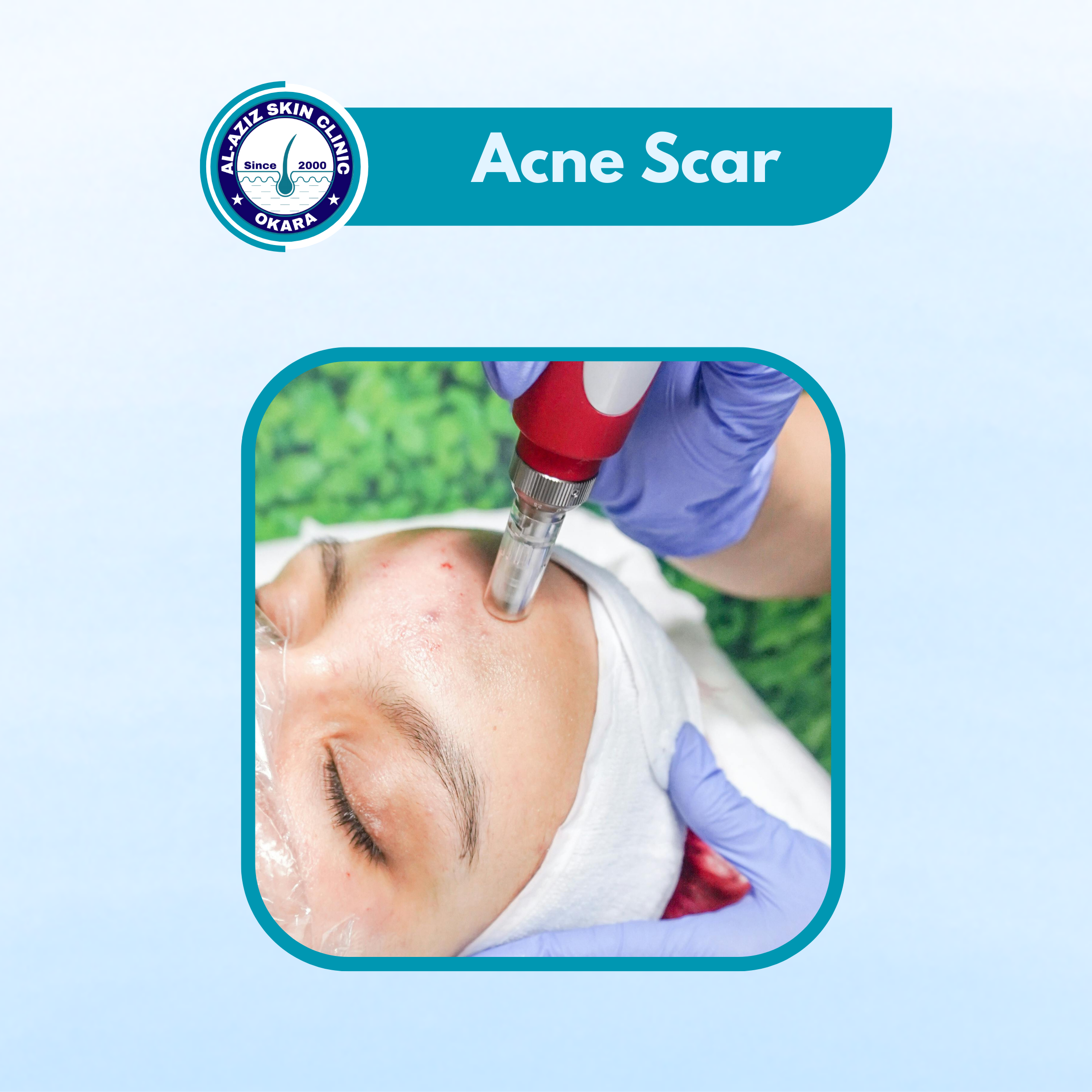 Acne Scar Treatment