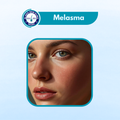 Melasma